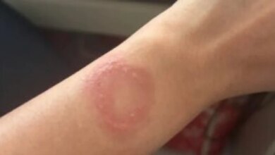 Apple Watch Overheat Picu Luka Bakar Permanen, Pengguna Keluhkan Penanganan Apple Support Berbelit